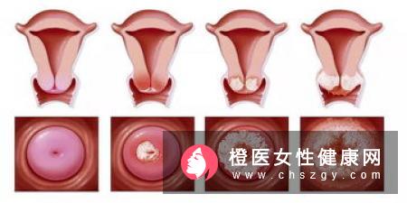 不同的白带颜色分别暗示着什么疾病