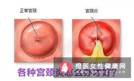 不同的白带颜色分别暗示着什么疾病