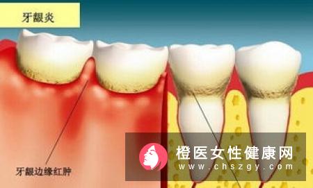 牙周炎疾病怎样治疗？