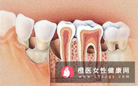 三种不同程度的牙周炎分别怎么治疗？